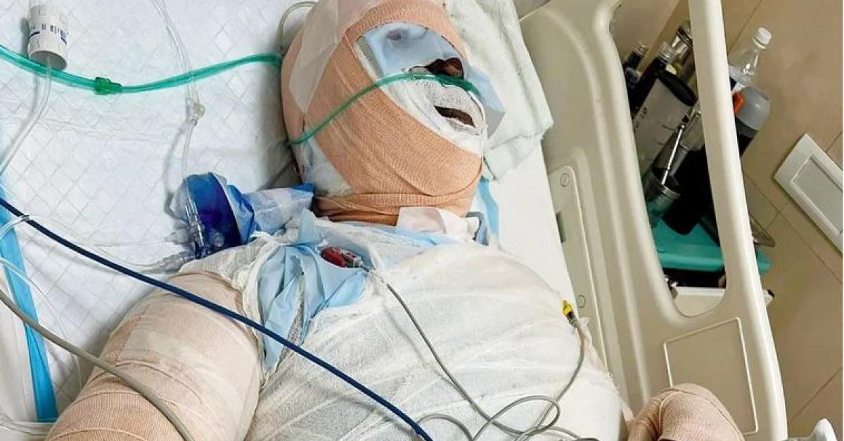Acid Attack 