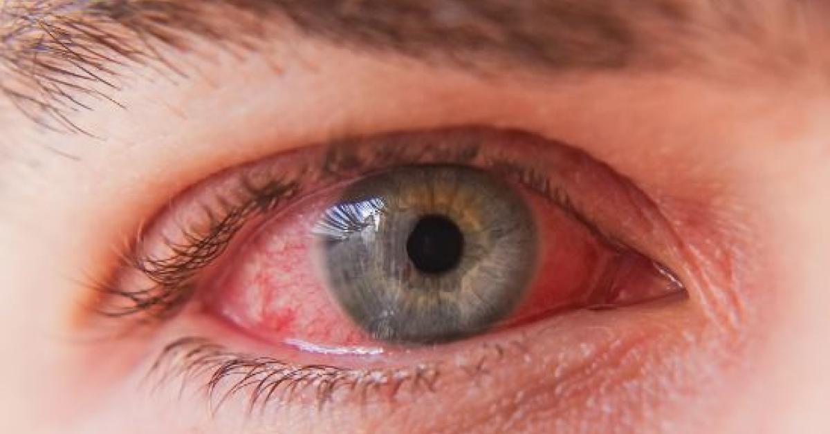 eye flu