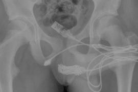 Teenager inserts USB Cable into urethra to measure genitals