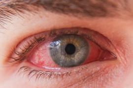 eye flu